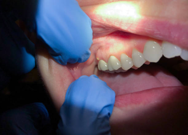 Best Emergency Root Canal Treatment in Takoma Park, MD